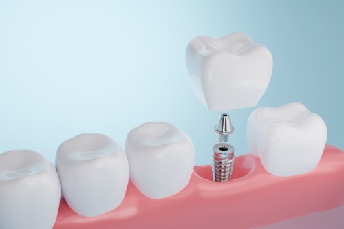 Implants